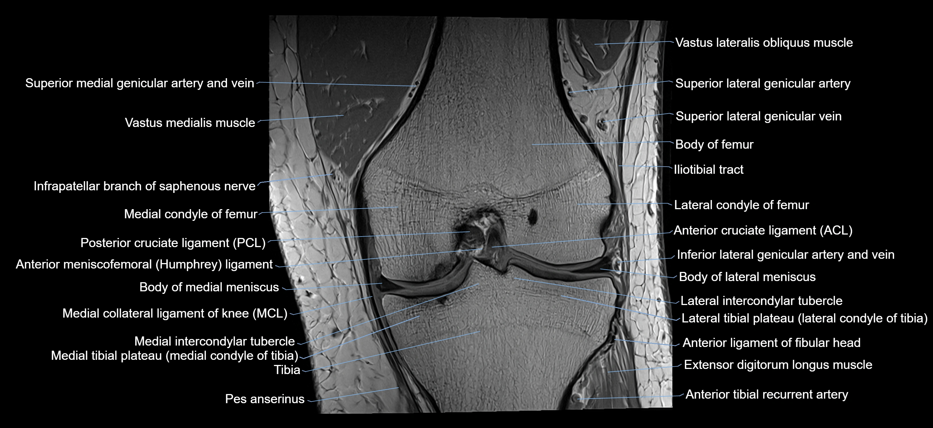 MRI knee coronal cross sectional anatomy labelled 3T radiology  image-04001-00021.webp